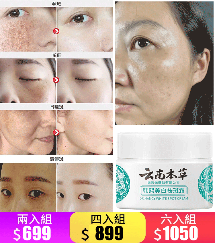 色斑、雀斑、老年斑，滿臉斑怎麼辦？用它，一抹淡斑！！雲南本草美白祛斑霜。